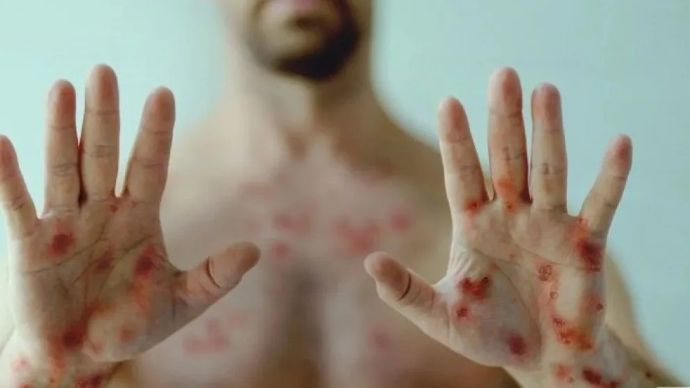 Alerta por el primer caso autóctono de viruela de mono: cuáles son los síntomas y cómo se transmite